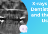 Dental X-rays and their Uses